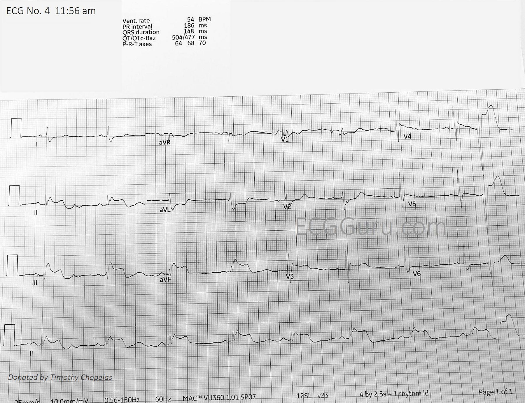 Posterior M I Ecg Guru Instructor Resources